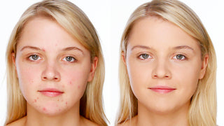 Acne/blemish Concealing Makeup using my Signature Pinpoint Technique